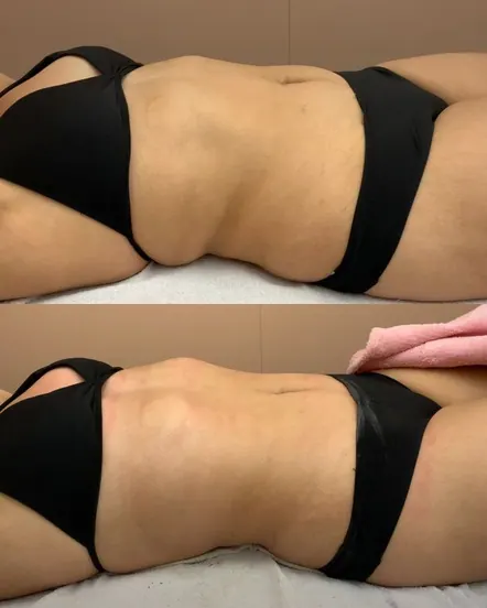 Antes e depois de massagem modeladora