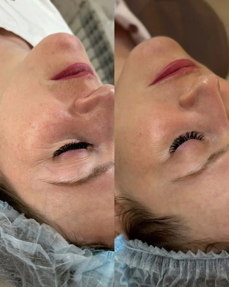 Antes e depois de microagulhamento: linhas finas suavizadas e pele mais firme